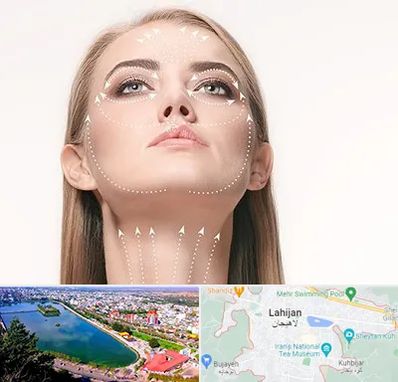 لیفت صورت با نخ در لاهیجان