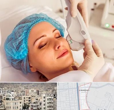 اکسنت در اسکندری