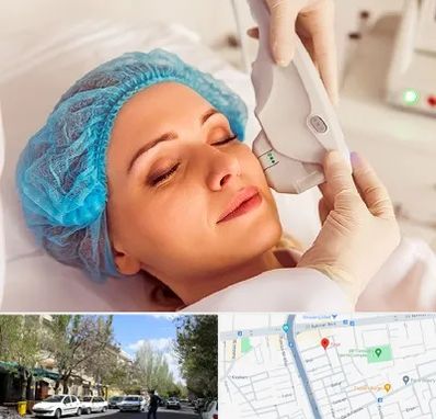 اکسنت در کوی فیروز تبریز