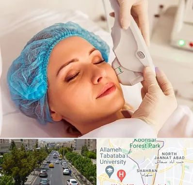 اکسنت در شهران 