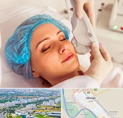 اکسنت در آبادان