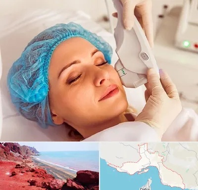 اکسنت در هرمزگان