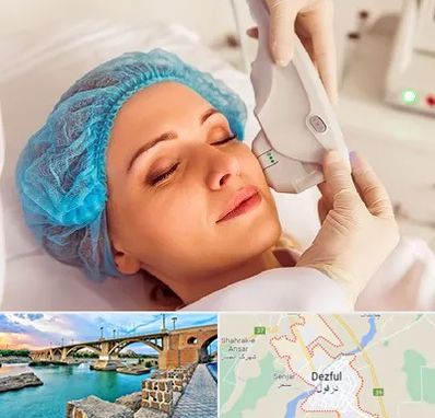 اکسنت در دزفول