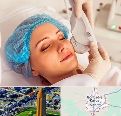 اکسنت در گنبد کاووس