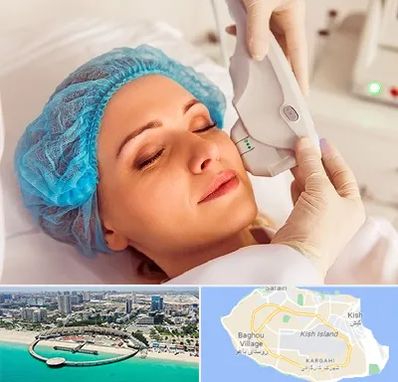 اکسنت در کیش