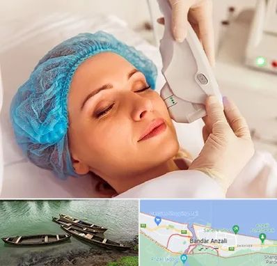 اکسنت در بندر انزلی