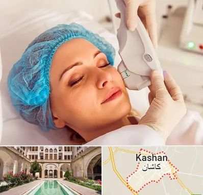 اکسنت در کاشان