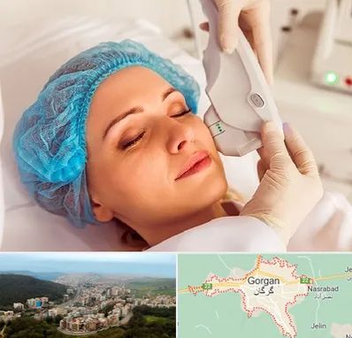 اکسنت در گرگان