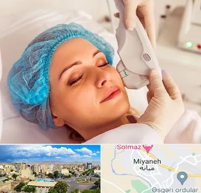 اکسنت در میانه