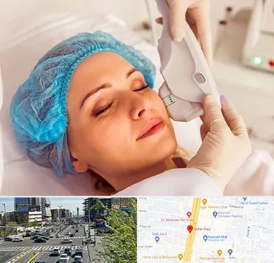 اکسنت در ستاری 