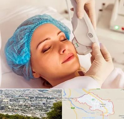 اکسنت در یاسوج