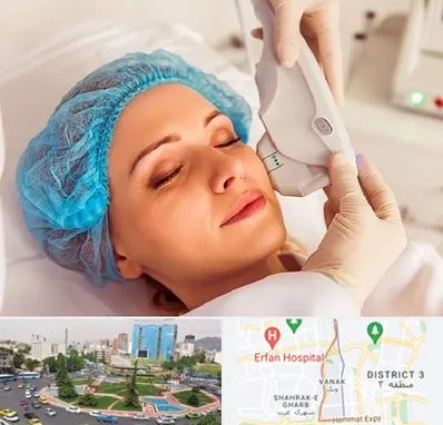 اکسنت در ونک 