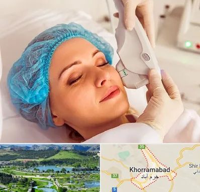 اکسنت در خرم آباد