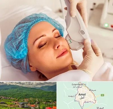 اکسنت در آمل