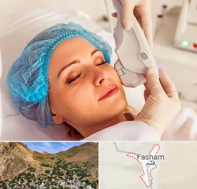 اکسنت در فشم