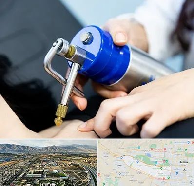 کرایوتراپی در منطقه 21 تهران 