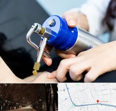 کرایوتراپی در ابوریحان تبریز