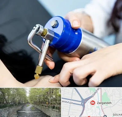 کرایوتراپی در زرگنده