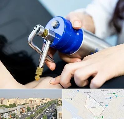 کرایوتراپی در کیانمهر کرج