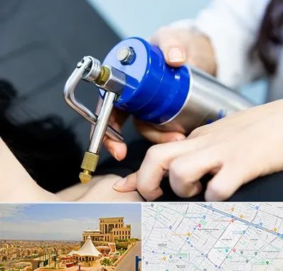 کرایوتراپی در هاشمیه مشهد