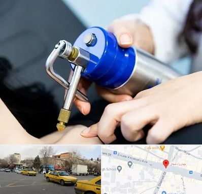 کرایوتراپی در شهناز تبریز