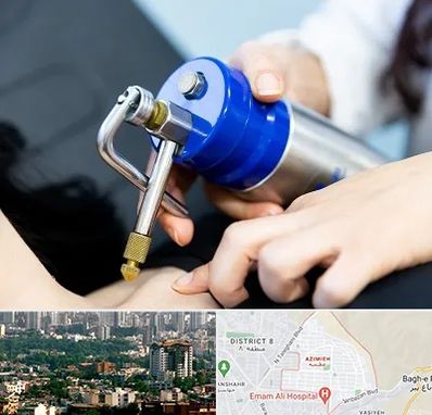 کرایوتراپی در عظیمیه کرج 