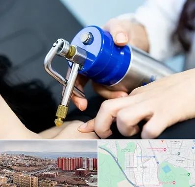 کرایوتراپی در سهند تبریز