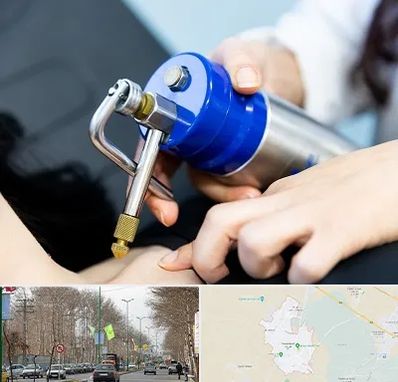 کرایوتراپی در نظرآباد کرج 