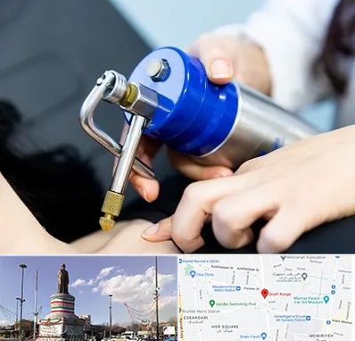 کرایوتراپی در کارگر جنوبی 