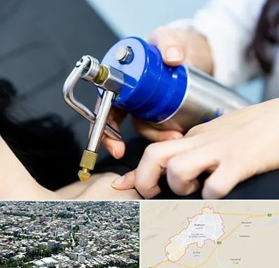 کرایوتراپی در شاهرود