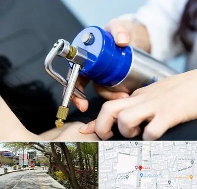 کرایوتراپی در خیابان توحید اصفهان