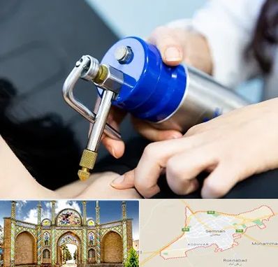 کرایوتراپی در سمنان