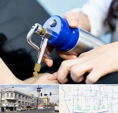 کرایوتراپی در 17شهریور