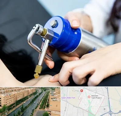 کرایوتراپی در فاز سه اندیشه
