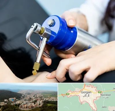 کرایوتراپی در گرگان