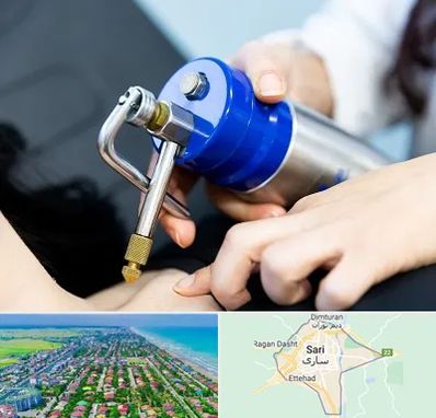 کرایوتراپی در ساری