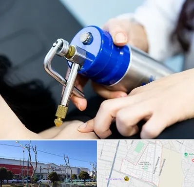کرایوتراپی در فاز دو اندیشه