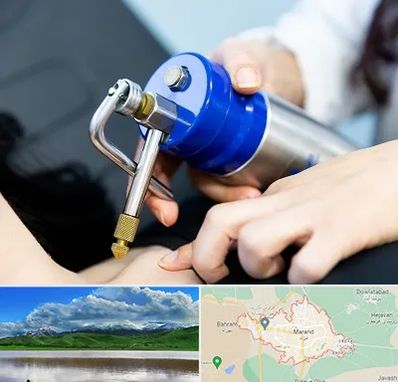 کرایوتراپی در مرند