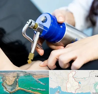 کرایوتراپی در سیستان و بلوچستان