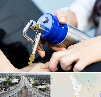 کرایوتراپی در اندیمشک