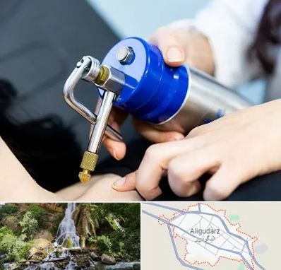 کرایوتراپی در الیگودرز