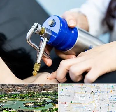 کرایوتراپی در منطقه 9 تهران 