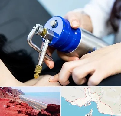 کرایوتراپی در هرمزگان