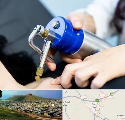 کرایوتراپی در بیجار