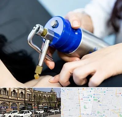 کرایوتراپی در منطقه 11 تهران 