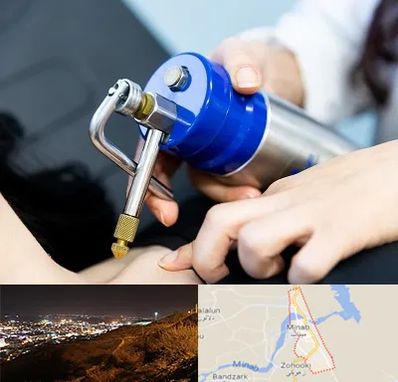 کرایوتراپی در میناب