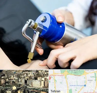 کرایوتراپی در مرزداران 