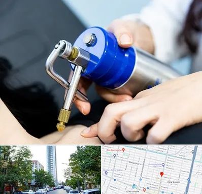 کرایوتراپی در امامت مشهد