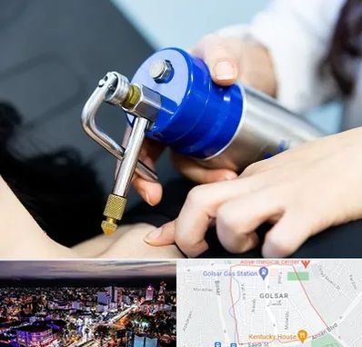 کرایوتراپی در گلسار رشت 