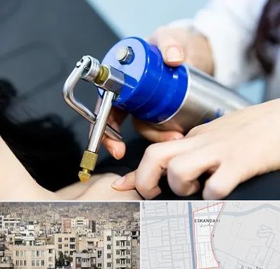 کرایوتراپی در اسکندری